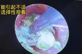 定期检查清理耳道，可视采耳轻松搞定，全程舒心，安心。视频封面