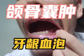 颌骨囊肿手术切除牙周病根管治疗，不痛不痒的牙龈血泡中医怎么治视频封面