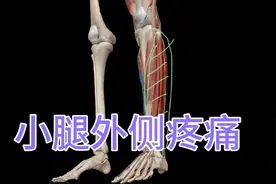 小腿外侧疼痛的治疗思路！视频封面