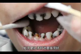 蛀牙是拔掉好还是补牙好？本期视频带您了解一下您的困惑。视频封面