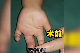 出生只有四根指，拍片后知道是复杂并指，看医生怎么巧妙分出五指视频封面