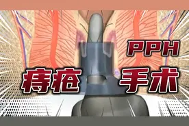 一分钟了解，痔疮手术是怎么做的！？“PPH”手术是什么？！