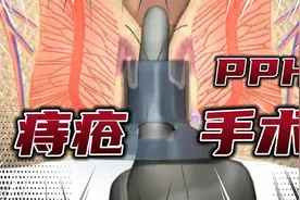 一分钟了解，痔疮手术是怎么做的！？“PPH”手术是什么？！视频封面