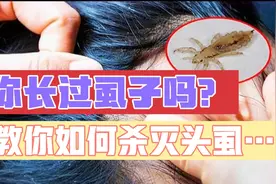 相信很多607080后都长过虱子吧，教你如何杀灭头虱，不再受罪…视频封面