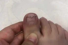 甲沟炎 指甲矫正 300元一根脚趾视频封面