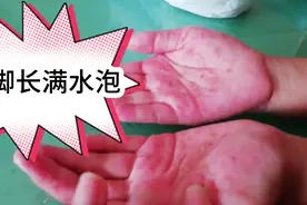 6岁宝贝手脚长满水泡：会是湿疹吗，医生开了中西结合药用，期待视频封面