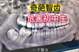 仁义牙医集团孙仁义医生科普：奇葩智齿，初中生必须知道的危害！