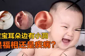 新生儿耳朵上有小洞，是福气的耳仓，还是要治的疾病？视频封面