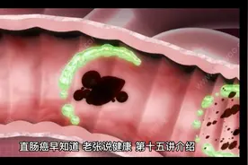 直肠癌早知道，老张说健康，第十五讲，不花一分钱自检自查直肠癌视频封面