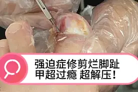 小姐姐脚趾头灰指甲都烂掉了修剪烂脚趾超过瘾超解压强迫症进来看视频封面