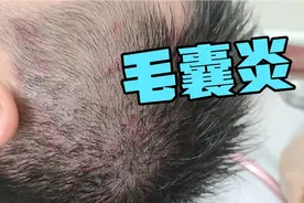 顽固头屑毛囊炎，用茶麸浆搭配茶油，深度清洁软化，排出好多油脂视频封面