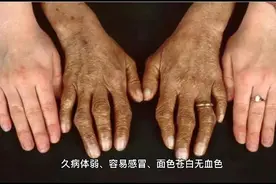 【健康生活】警惕！6种出汗是身体在“呼救”！视频封面