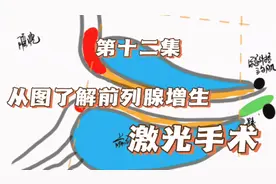 从图了解前列腺增生第十二集-激光手术，怎么做？并发症如何？视频封面