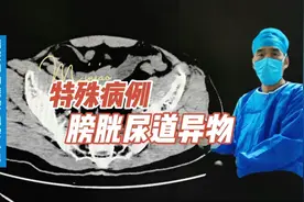 这是一个特殊病例，膀胱尿道异物。视频封面