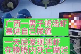 惊奇！男子将活虾塞进自己体内！最后只能手术取出死亡腐烂的死虾视频封面