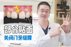部分贴面-关闭门牙缝隙视频封面