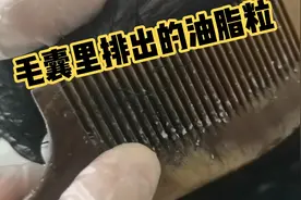 脱发头屑头油头痒毛囊炎，都是毛囊被油脂堵塞，视频分享疏通毛囊视频封面