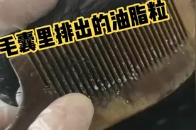 脱发头屑头油头痒毛囊炎，都是毛囊被油脂堵塞，视频分享疏通毛囊视频封面
