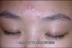 青春痘的预防和护理视频封面