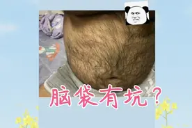 孩子后脑勺怎么有个坑视频封面
