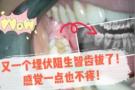 原来拔牙一点也不疼！你相信吗？视频封面
