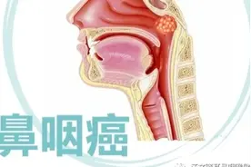 以耳鸣，听力下降为首发症状的鼻咽癌#医学科普 #鼻咽癌视频封面