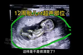 12周3胎儿nt超声部位讲解视频封面