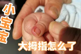 今天晚饭后，无意看到小宝大拇指红肿，那照片去医院说甲沟炎！！视频封面