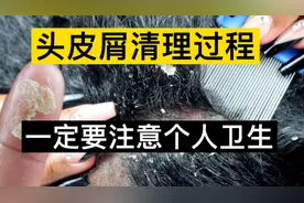小姐姐太久没洗头，头上都是头皮屑，头皮屑清理