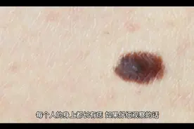 脖子后的痣是好是坏？视频封面