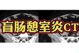 女性患者，右下腹痛入院，CT平扫诊断什么？医生讲解！视频封面