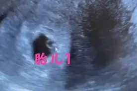 做试管怀上双胞胎，且一超检查双胞胎都见胎心了！恭喜准爸妈☺️视频封面