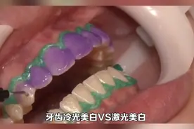 牙齿冷光美白VS激光美白视频封面