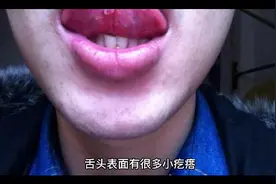 舌头上为什么有那么多小疙瘩视频封面