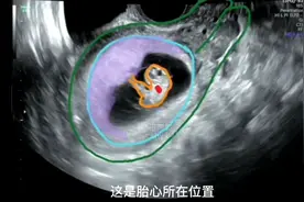 超声讲解9周胎儿初具人形可爱的样子，孕妈第一次B超现惊喜！