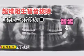 超难阻生智齿拔除，不看不知道，一看吓一跳，拔完后变成猪头视频封面