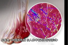 痛风发作了，医生开了小苏打片，这不是治胃病的吗？是否开错了？视频封面