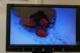 重庆慢性前列腺炎病友，前列腺小管堵塞时间太长，结石堵满了视频封面