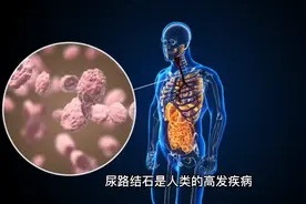 医学专家称常吃即食米糠有助于预防尿路结石和癌症视频封面