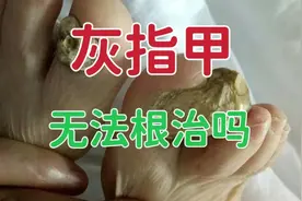 灰指甲不能根治吗？了解灰指甲3大真菌和3大感染途径后，就明白了视频封面