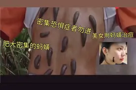吸血成性的蚂蟥进入人身体会怎样？不敢想象美女竟用蚂蟥治顽固痘