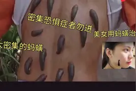 吸血成性的蚂蟥进入人身体会怎样？不敢想象美女竟用蚂蟥治顽固痘视频封面