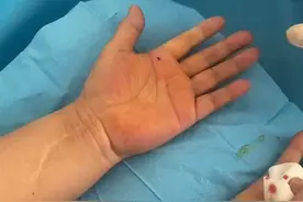 腱鞘炎  小针刀治疗  立竿见影