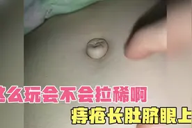 你的痔疮怎么长在肚脐眼上！视频封面