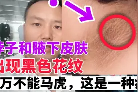 体质胖的孩子脖子和腋下皮肤有这种情况，家长注意不能马虎！切记视频封面