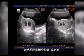 张女士怀了一对双胞胎，但结局却让她痛苦万分！