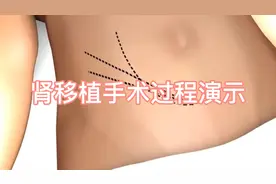 肾移植手术全过程演示，看完太过瘾！视频封面