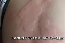 引起儿童荨麻疹的原因视频封面
