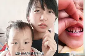 一岁半宝宝上唇系带长这样，奶奶说要手术，宝妈被吓到了，求助！视频封面