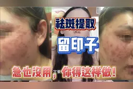 听信美容院中药提取祛斑后留下满脸印子又红又黑修复退黑来得及吗视频封面